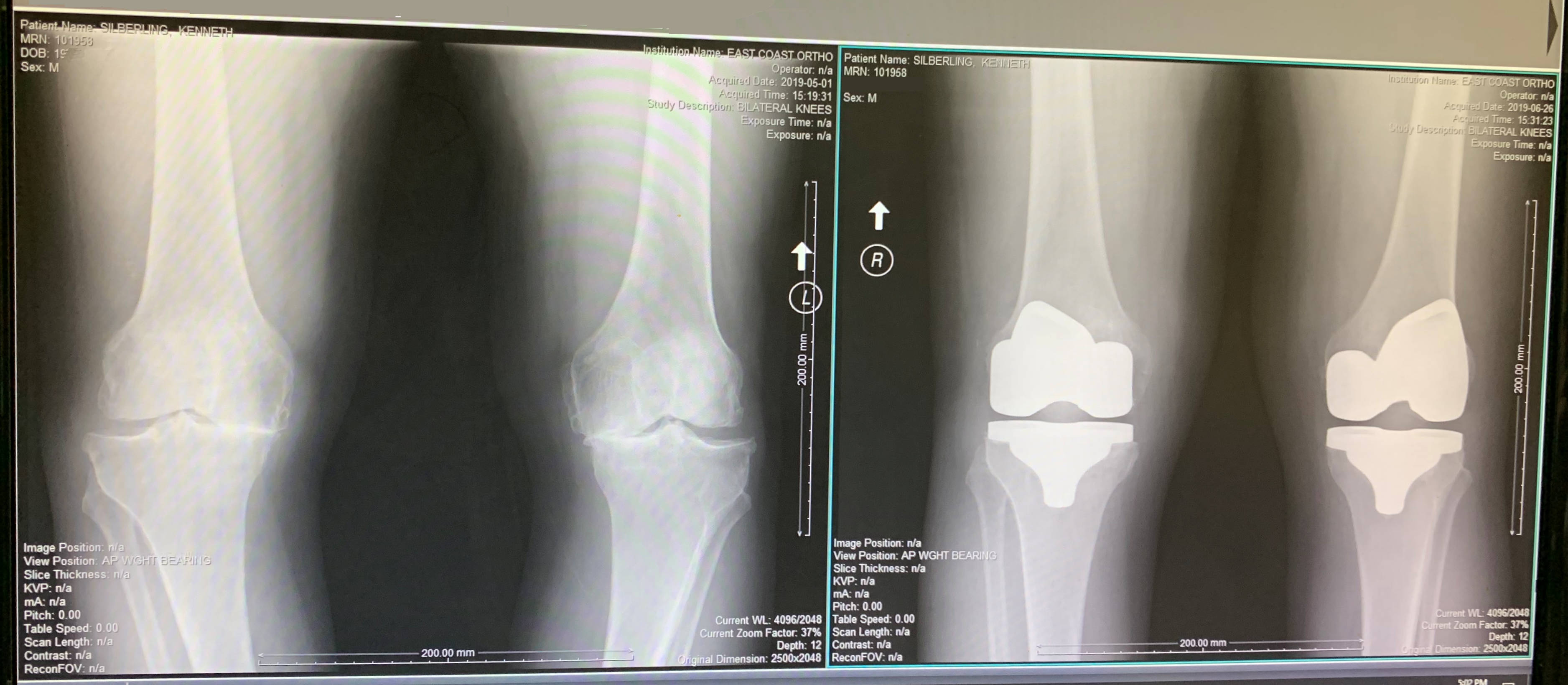 Knee Replacement Surgery - Bone on bone to titanium